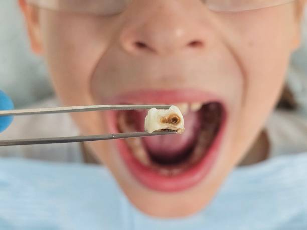 Best Emergency Dental Care for Broken or Chipped Teeth in Evergreen, CO